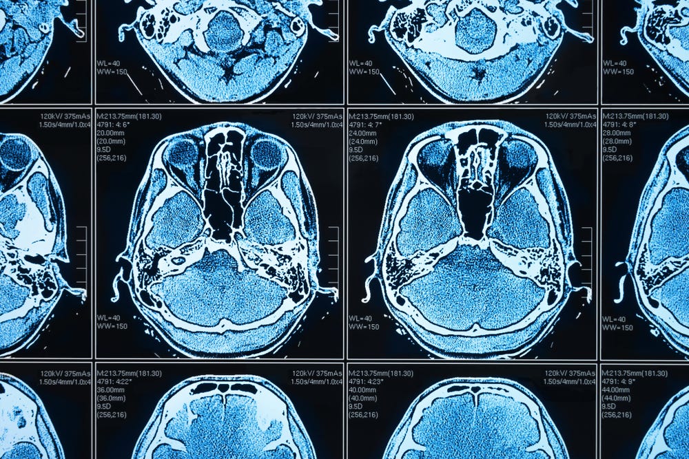 3D Brain Tumor Segmentation (Image via Shutterstock under license to Andreas Kopp)